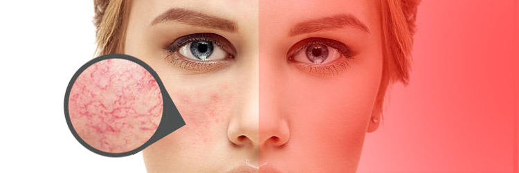 Red Light Therapy for Scar Reduction